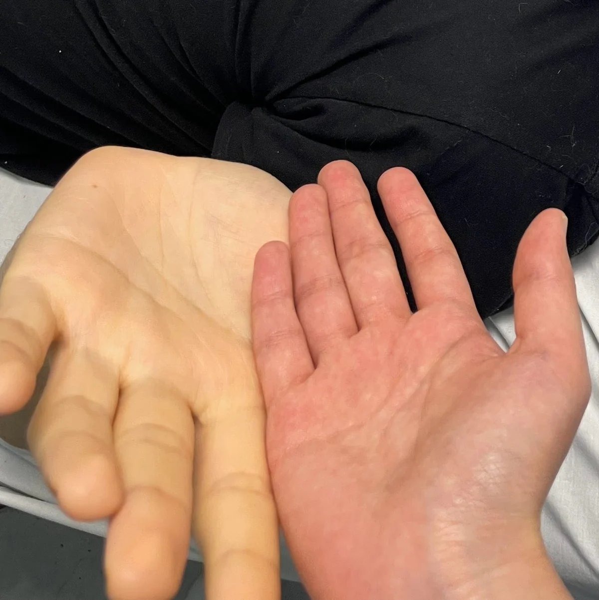 Two hands side by side in the emergency room, showing a marked difference in skin tone.